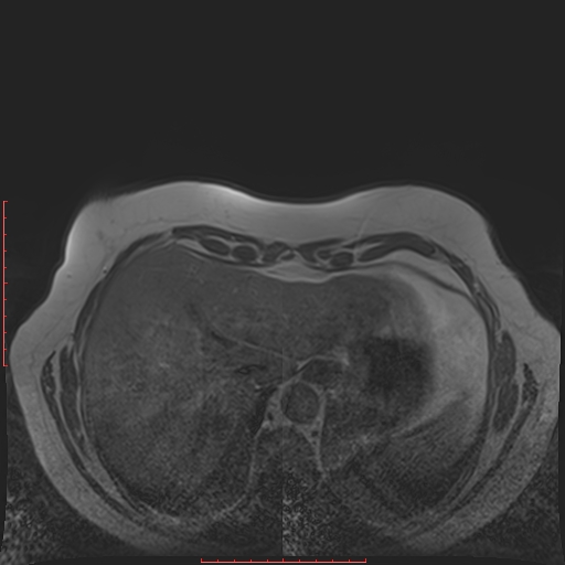File:Bilateral breast implant rupture (Radiopaedia 24761-25027 T1 36).jpg