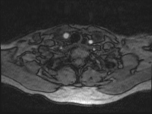 Bilateral carotid body tumors and right glomus jugulare tumor (Radiopaedia 20024-20060 Axial MRA 192).jpg