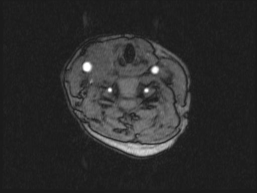 Bilateral carotid body tumors and right glomus jugulare tumor (Radiopaedia 20024-20060 Axial MRA 235).jpg