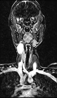 Bilateral carotid body tumors and right glomus jugulare tumor (Radiopaedia 20024-20060 MRA 85).jpg