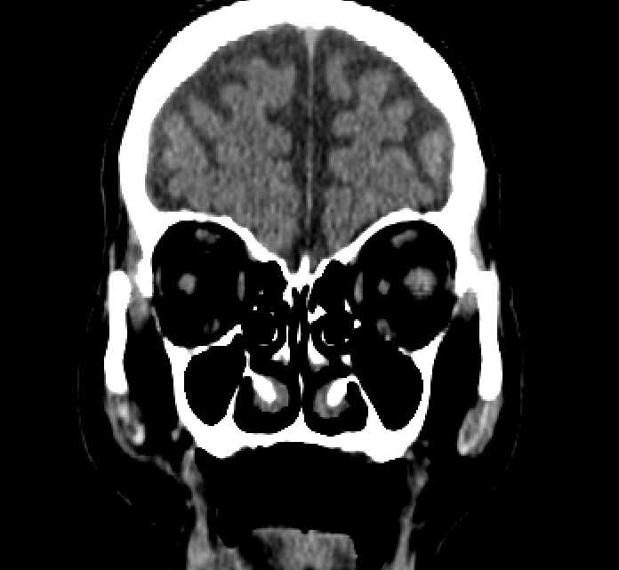 Bilateral ectopia lentis (Radiopaedia 89889-107013 Coronal non-contrast 56).jpg