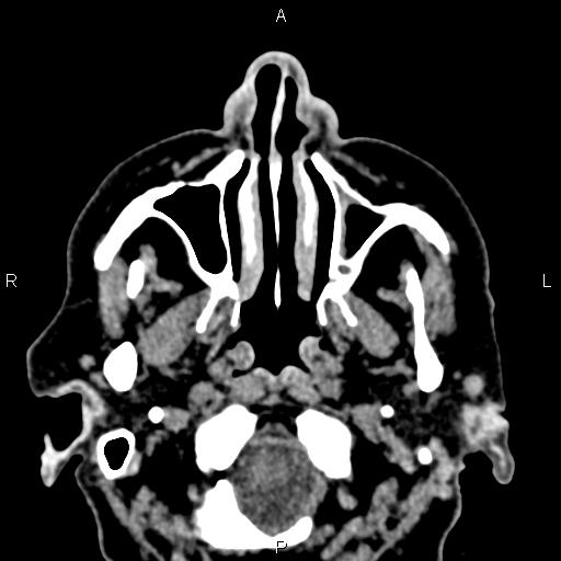 Bilateral enlargement of lacrimal glands - sarcoidosis (Radiopaedia 62627-70921 Axial non-contrast 2).jpg