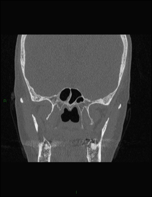 Bilateral frontal mucoceles (Radiopaedia 82352-96454 Coronal 227).jpg
