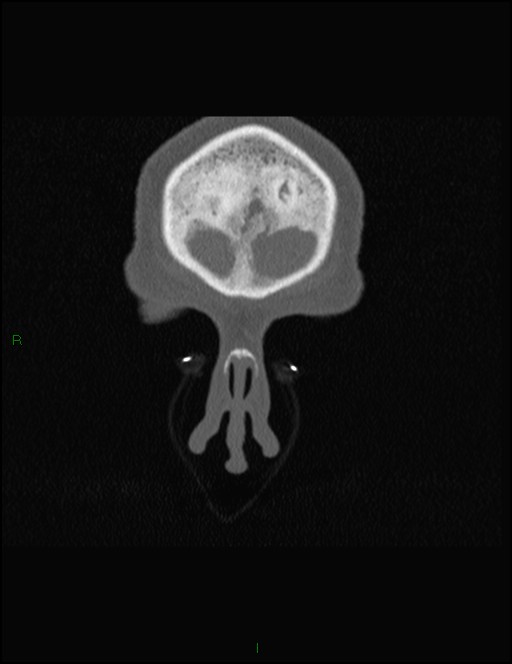 Bilateral frontal mucoceles (Radiopaedia 82352-96454 Coronal 36).jpg