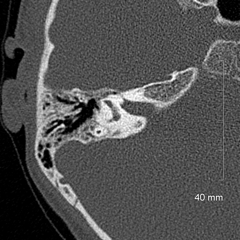 Bilateral grommets (Radiopaedia 47710-52404 Axial bone window 46).jpg