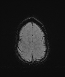 Bilateral mesial temporal polymicrogyria (Radiopaedia 76456-88181 Axial SWI 62).jpg