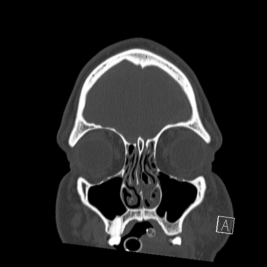 Bilateral occipital condyle fracture (type 2) (Radiopaedia 87675-104089 Coronal bone window 5).jpg