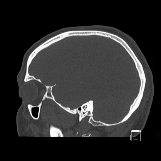 Bilateral occipital condyle fracture (type 2) (Radiopaedia 87675-104089 Sagittal bone window 21).jpg