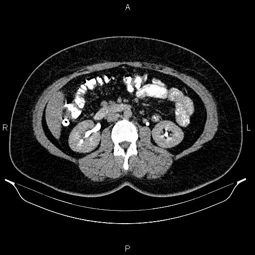 Bilateral ovarian dermoid cysts (Radiopaedia 85785-101603 Axial C+ delayed 33).jpg