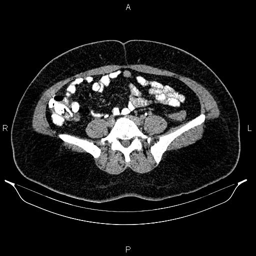 Bilateral ovarian dermoid cysts (Radiopaedia 85785-101603 Axial C+ delayed 52).jpg