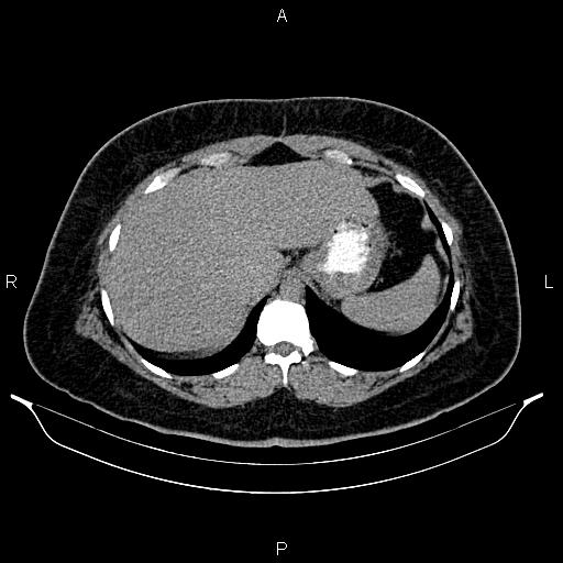 Bilateral ovarian dermoid cysts (Radiopaedia 85785-101603 Axial C+ delayed 6).jpg
