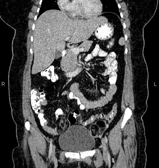 File:Bilateral ovarian dermoid cysts (Radiopaedia 85785-101603 C 18).jpg