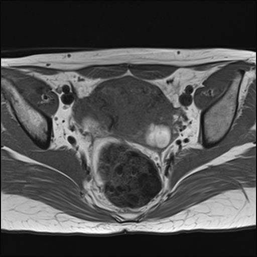 File:Bilateral ovarian endometriomas (Radiopaedia 87085-103347 Axial T1 11).jpg