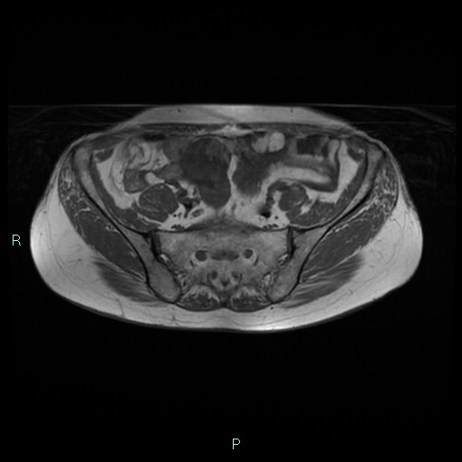 File:Bilateral ovarian fibroma (Radiopaedia 44568-48293 Axial T1 6).jpg