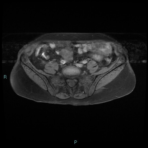 File:Bilateral ovarian fibroma (Radiopaedia 44568-48293 Axial T1 fat sat 3).jpg