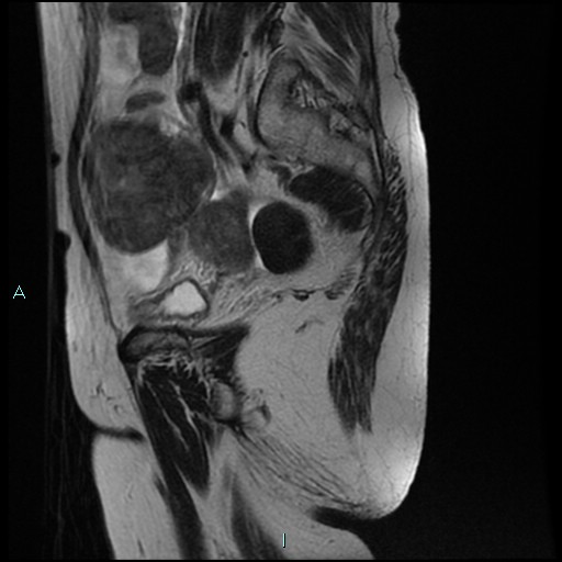 File:Bilateral ovarian fibroma (Radiopaedia 44568-48293 Sagittal T2 10).jpg