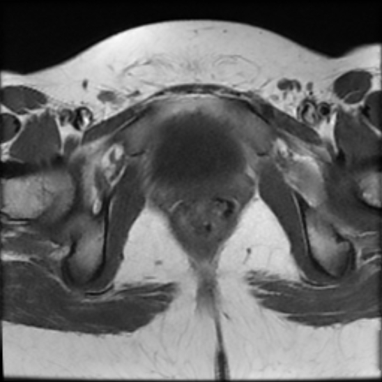 File:Bilateral ovarian fibrothecomas - adolescent (Radiopaedia 86604-102707 Axial T1 26).jpg
