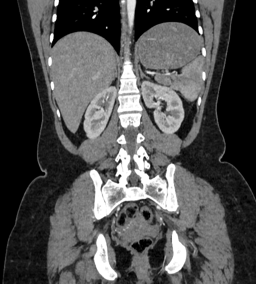 File:Bilateral ovarian mature cystic teratomas (Radiopaedia 79373-92457 B 65).jpg