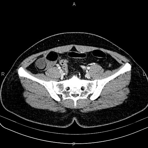 File:Bilateral ovarian teratoma (Radiopaedia 83131-97503 Axial With contrast 25).jpg