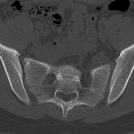 Bilateral pars defect (Radiopaedia 26691-26846 Axial bone window 96).jpg