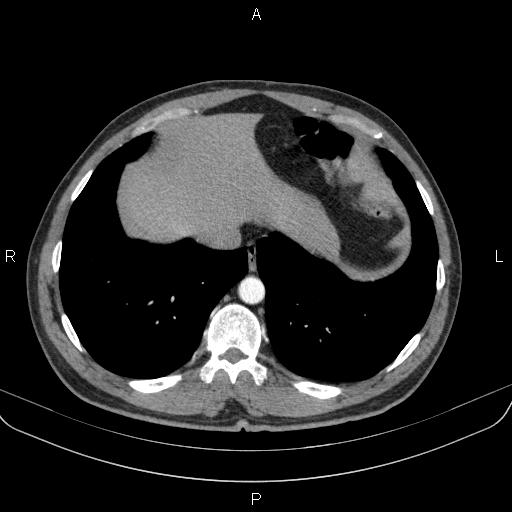 Bilateral pulmonary AVM (Radiopaedia 83134-97505 A 59).jpg