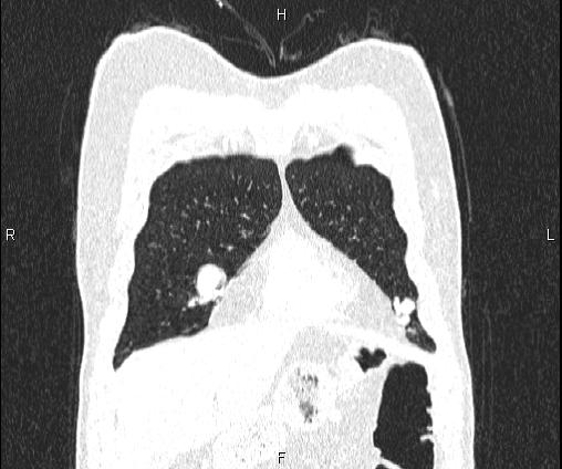 Bilateral pulmonary AVM (Radiopaedia 83134-97505 Coronal lung window 20).jpg