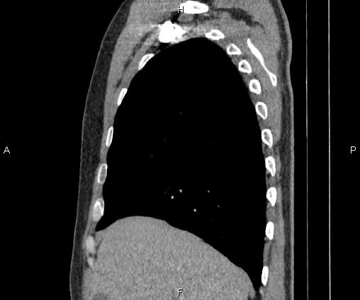 Bilateral pulmonary AVM (Radiopaedia 83134-97505 D 33).jpg