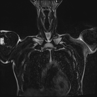 Bilateral spinoglenoid notch ganglion cysts (Radiopaedia 29577-30082 Coronal T2 24).jpg