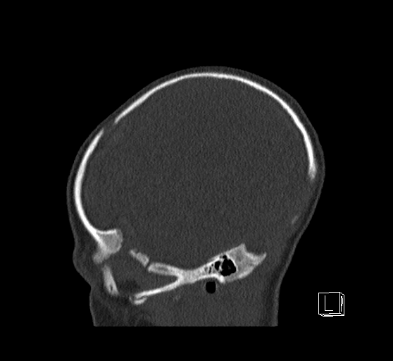 File:Bilateral subdural hemorrhage and parietal skull fracture (Radiopaedia 26058-26192 Sagittal bone window 16).png