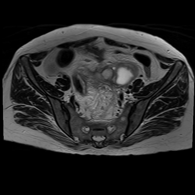 Bilateral tubo-ovarian abscesses (Radiopaedia 58635-65829 Axial T2 13).jpg