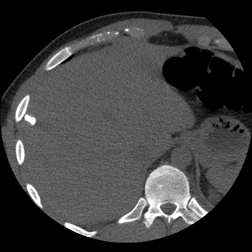 Bile leak from liver traumatic laceration (Radiopaedia 63463-72077 Axial Biliscopin 21).jpg