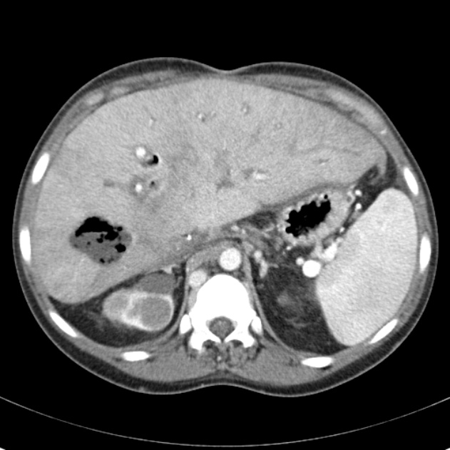 Biliary necrosis - liver transplant (Radiopaedia 21876-21846 B 20).jpg