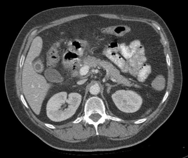 File:Bleeding duodenal ulcer and adenomyomatosis of gallbladder (Radiopaedia 61834-69861 A 37).jpg