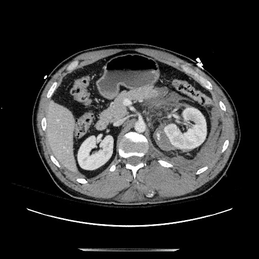Blunt abdominal trauma with solid organ and musculoskelatal injury with active extravasation (Radiopaedia 68364-77895 A 50).jpg