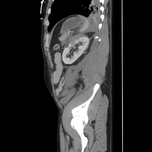Blunt abdominal trauma with solid organ and musculoskelatal injury with active extravasation (Radiopaedia 68364-77895 C 110).jpg