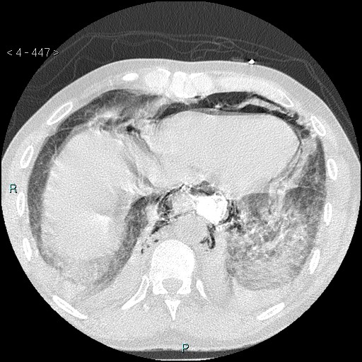 Boerhaave syndrome (Radiopaedia 27683-27897 lung window 79).jpg