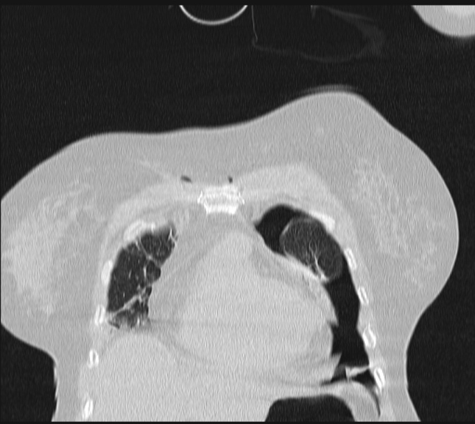 Boerhaave syndrome (Radiopaedia 45644-49799 Coronal lung window 14).jpg