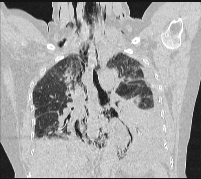 Boerhaave syndrome (Radiopaedia 45644-49799 Coronal lung window 41).jpg
