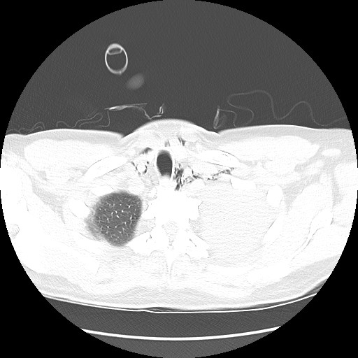 Boerhaave syndrome (Radiopaedia 59796-67310 Axial lung window 11).jpg