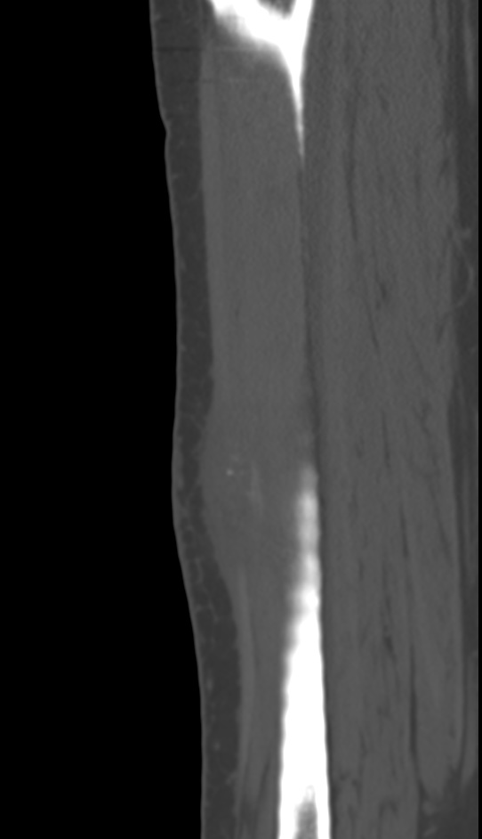 Bone metastasis - tibia (Radiopaedia 57665-64609 Sagittal bone window 116).jpg