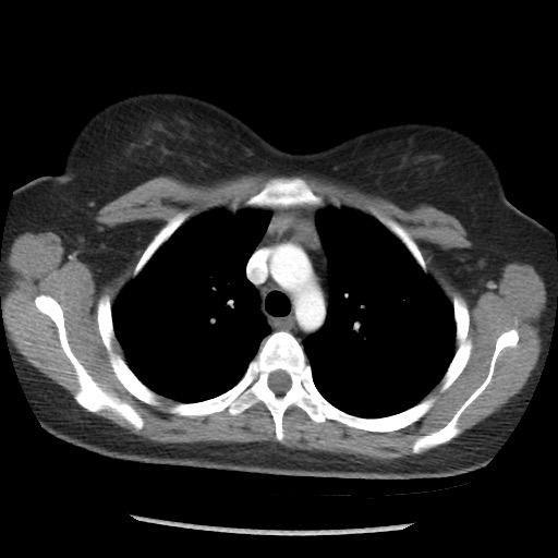File:Borderline mucinous tumor (ovary) (Radiopaedia 78228-90808 A 15).jpg