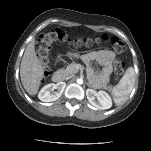 File:Borderline mucinous tumor (ovary) (Radiopaedia 78228-90808 A 51).jpg