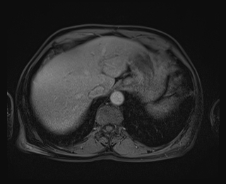 Bouveret syndrome (Radiopaedia 61017-68856 Axial T1 C+ fat sat 15).jpg