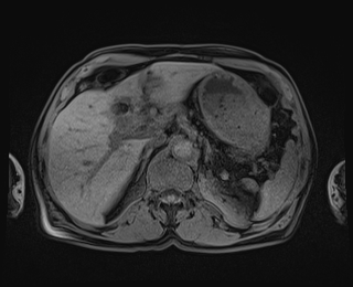 Bouveret syndrome (Radiopaedia 61017-68856 Axial T1 fat sat 25).jpg