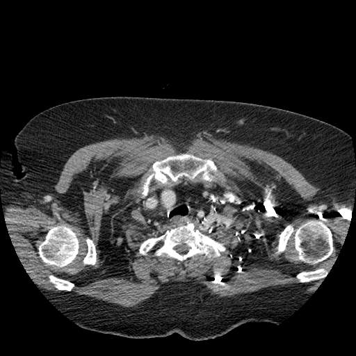 Bovine aortic arch - right internal mammary vein drains into the superior vena cava (Radiopaedia 63296-71875 A 11).jpg