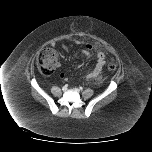 File:Bowel and splenic infarcts in acute lymphocytic leukemia (Radiopaedia 61055-68915 A 93).jpg