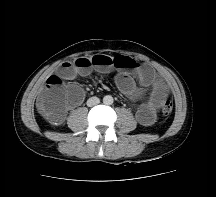 Bowel obstruction from colon carcinoma (Radiopaedia 22995-23028 A 48).jpg
