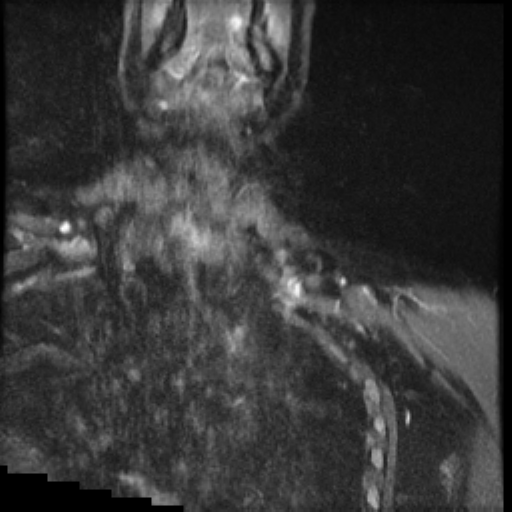 File:Brachial plexus neurofibroma (Radiopaedia 28030-28291 Coronal STIR 15).png