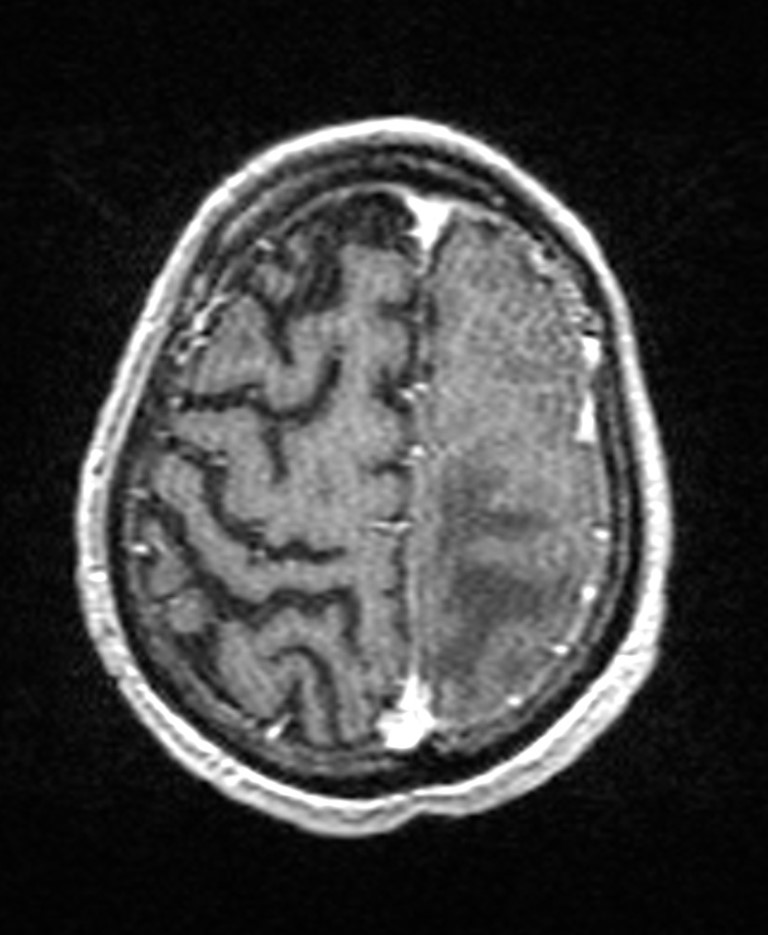 Brain abscess with dual rim sign (Radiopaedia 87566-103938 Axial T1 C+ 133).jpg