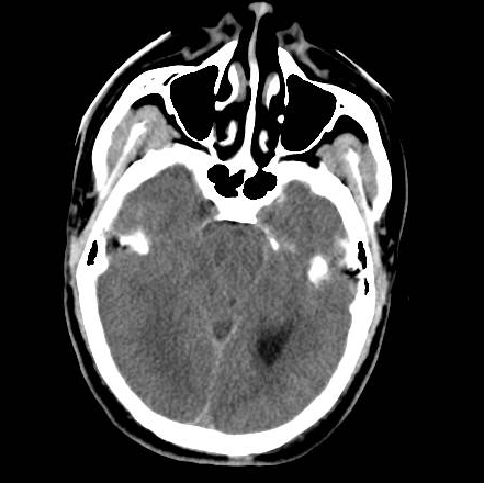 File:Brain death after motor vehicle collision (Radiopaedia 88470-105114 Axial 9).png